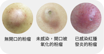 58+ 粉 瘤 画像 31 粉瘤‣ 麗式診所