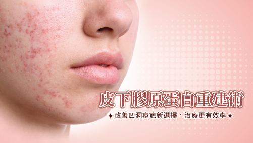 Read more about the article 皮下膠原蛋白重建術