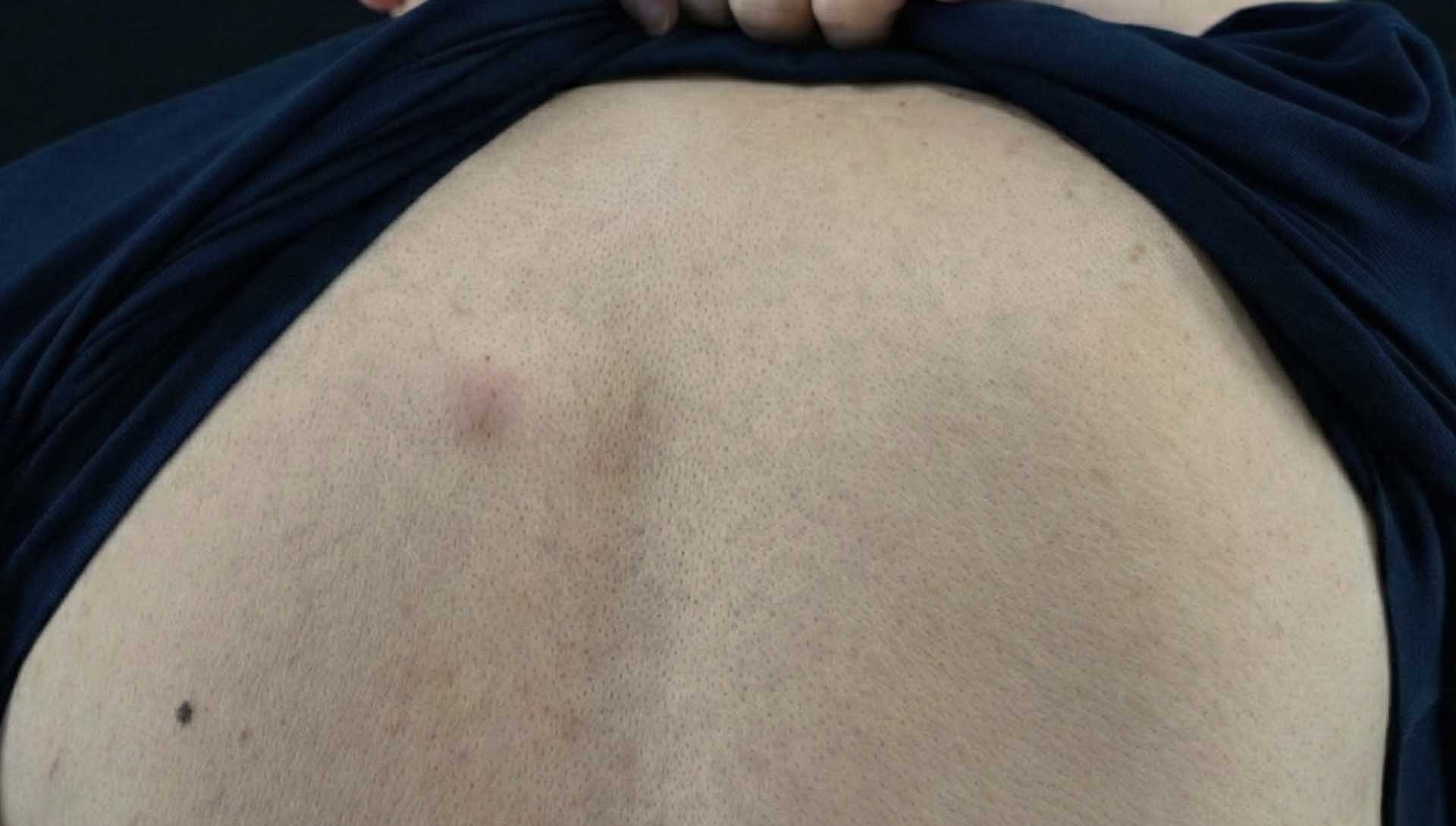 背部皮膚可見數個隆起的皮下腫塊，作為復發與多發性粉瘤的衛教示意