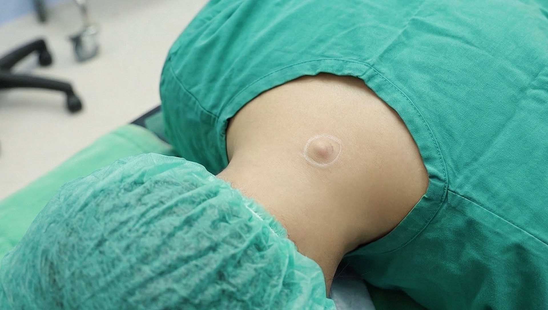 醫療人員評估皮下囊腫的情境示意圖