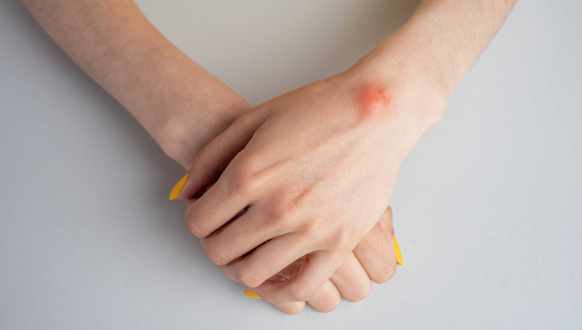 疼痛性皮下腫塊，手部皮下腫塊與局部紅腫情境示意