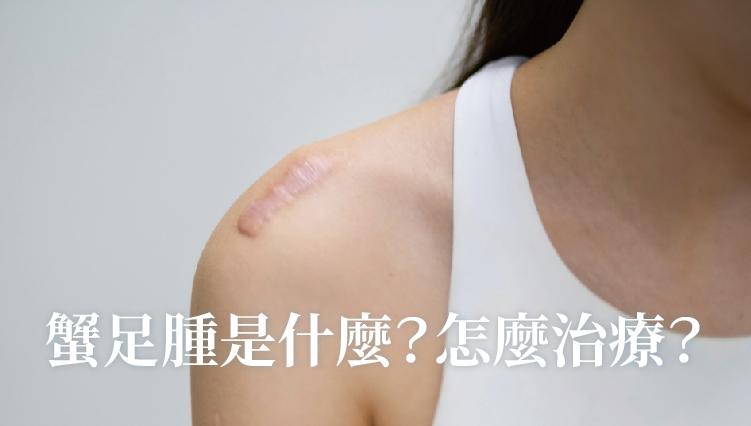 Read more about the article 蟹足腫