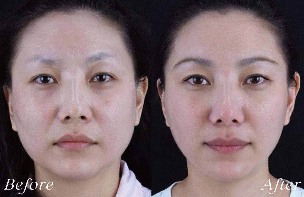 線雕術前後案例，臉部拉提緊緻，法令紋改善