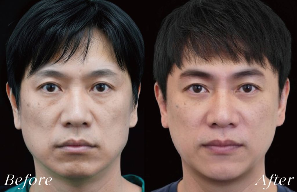 線雕術前後案例，筋膜拉提緊緻，法令紋改善