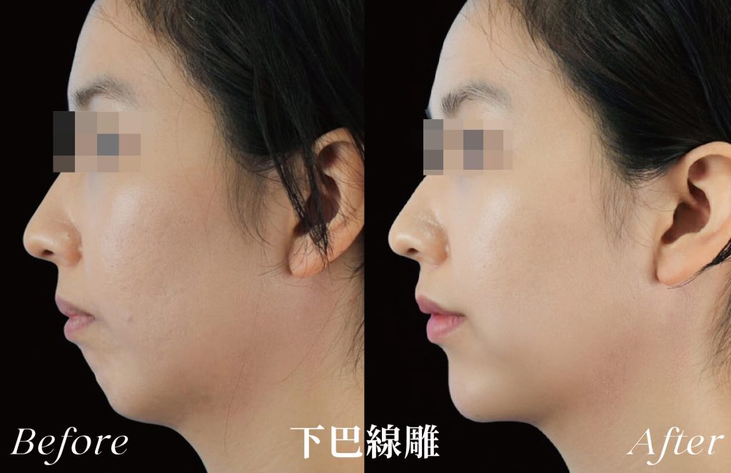 線雕術前後案例，下巴線條改善