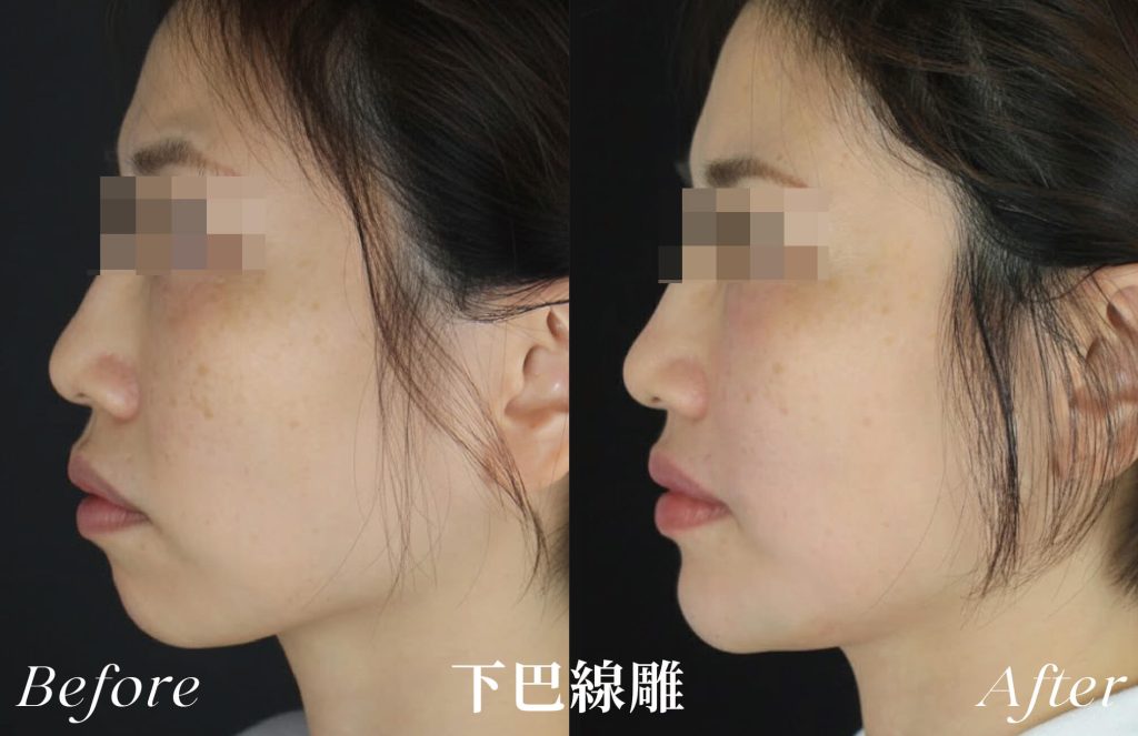 線雕術前後案例，下巴線條改善