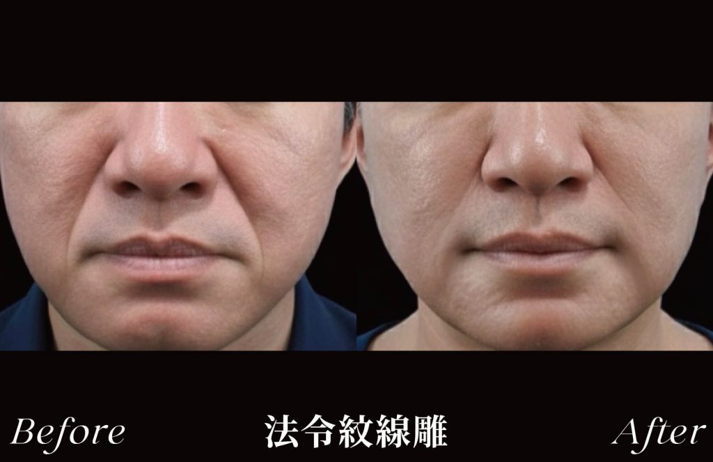 雕術前後案例，臉部拉提緊緻，法令紋改善