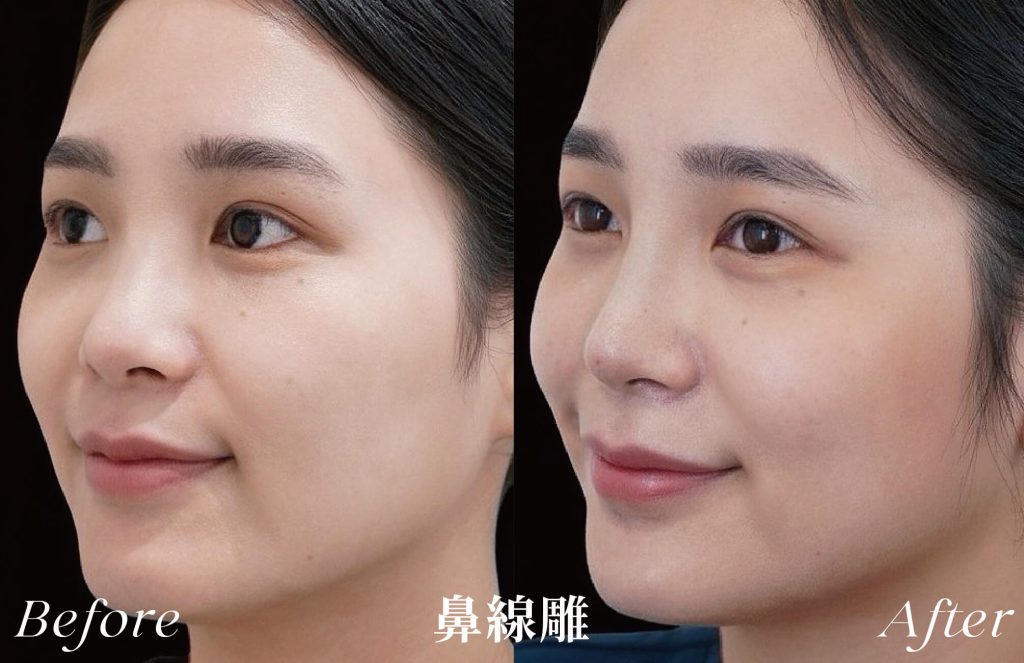 線雕術前後案例