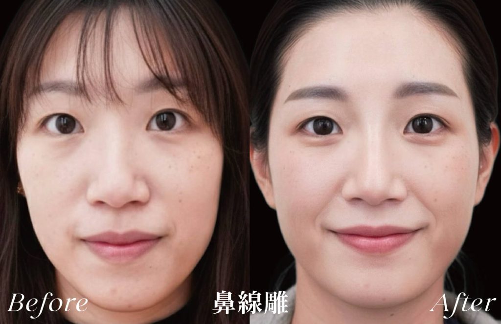 線雕術前後案例