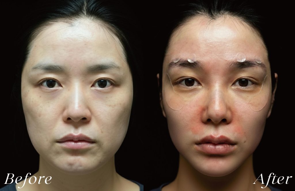 線雕術前後案例，幼態感臉型