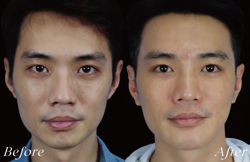 線雕術前後案例，幼態感臉型