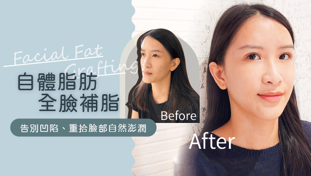 Read more about the article 自體脂肪全臉補脂