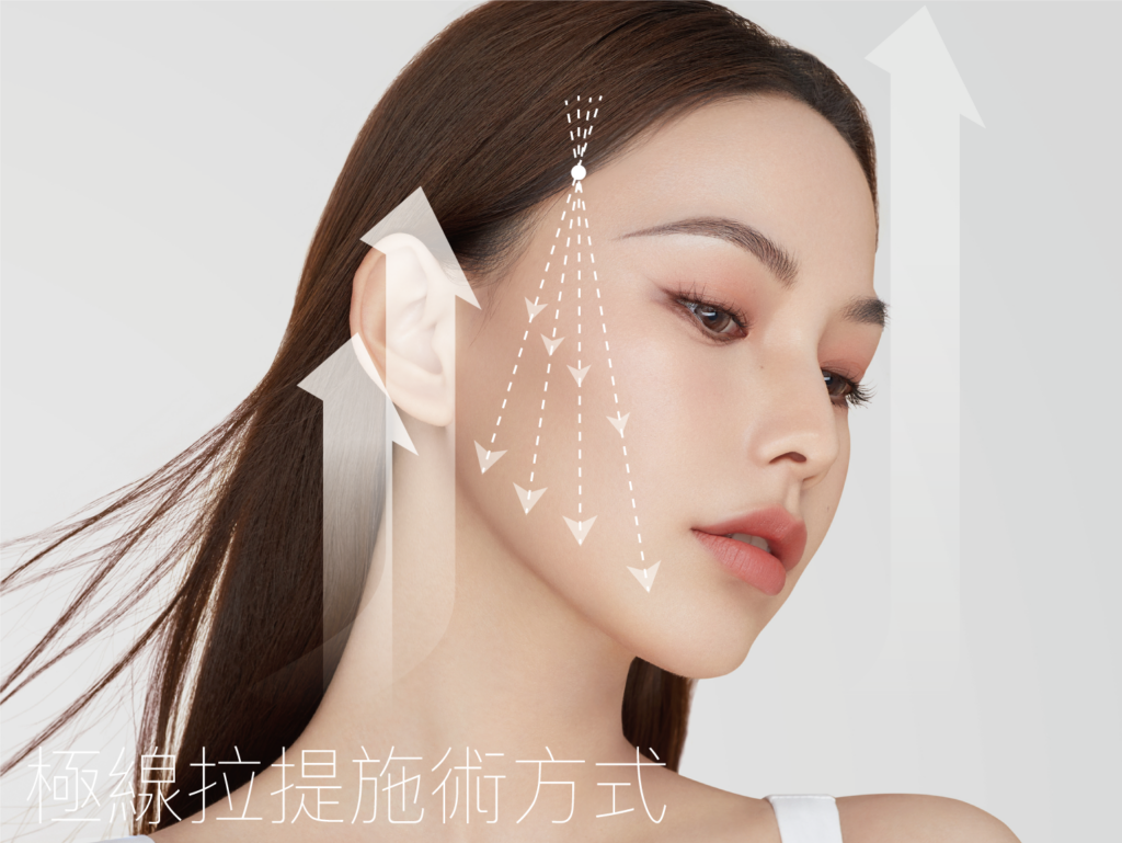 埋線拉提的施術方式