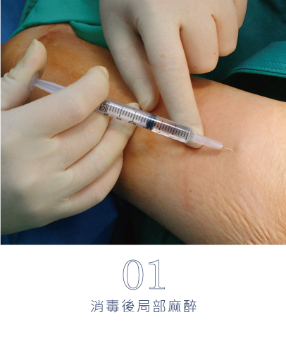 微創旋轉刀除臭術-14