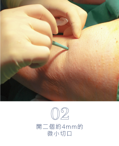 微創旋轉刀除臭術-15
