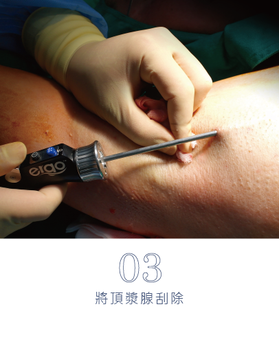 微創旋轉刀除臭術-16