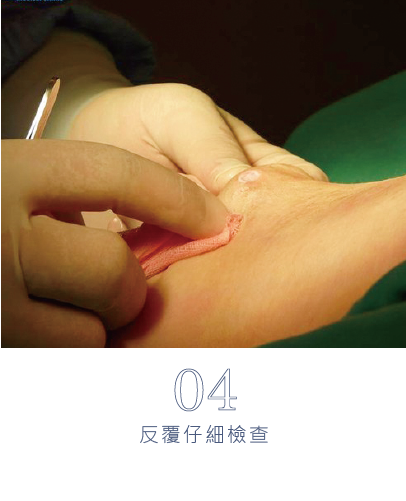 微創旋轉刀除臭術-17