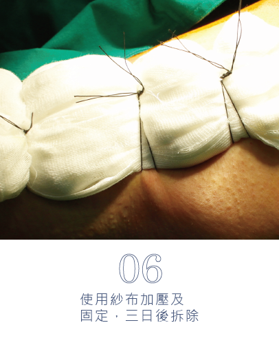 微創旋轉刀除臭術-19
