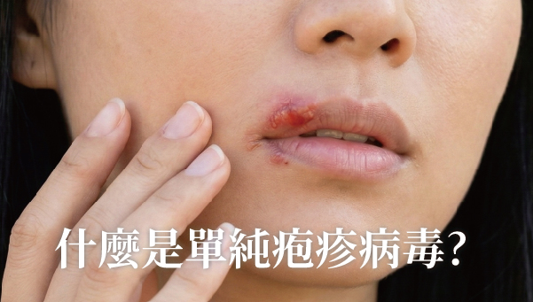 Read more about the article 單純皰疹