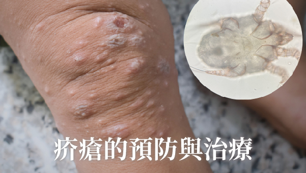 Read more about the article 疥瘡