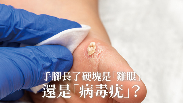 Read more about the article 病毒疣