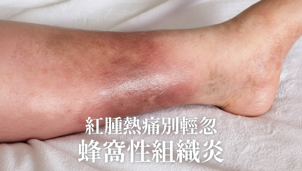 Read more about the article 蜂窩性組織炎