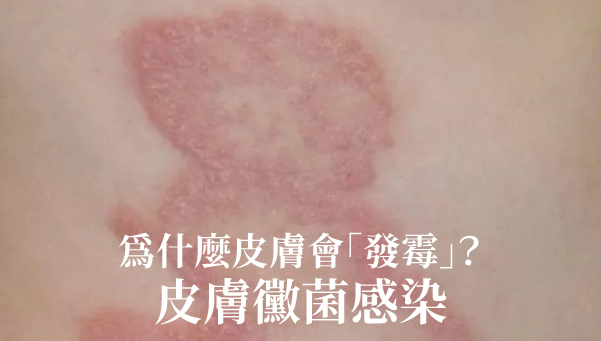 Read more about the article 黴菌感染